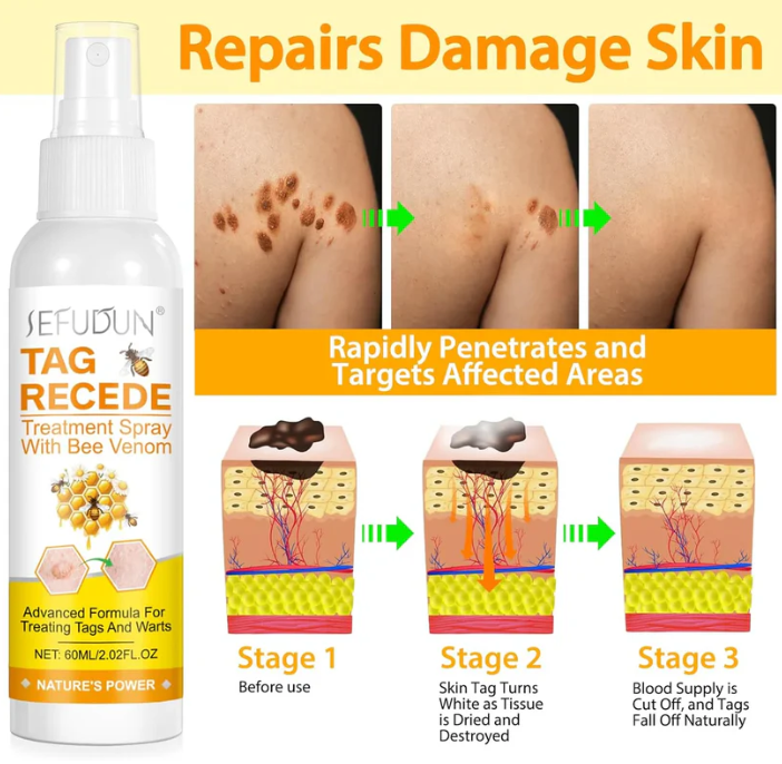 Tag Recede Eliminador de verrugas